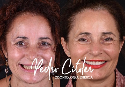 Pacientes que viajan en España para hacerse carillas dentales